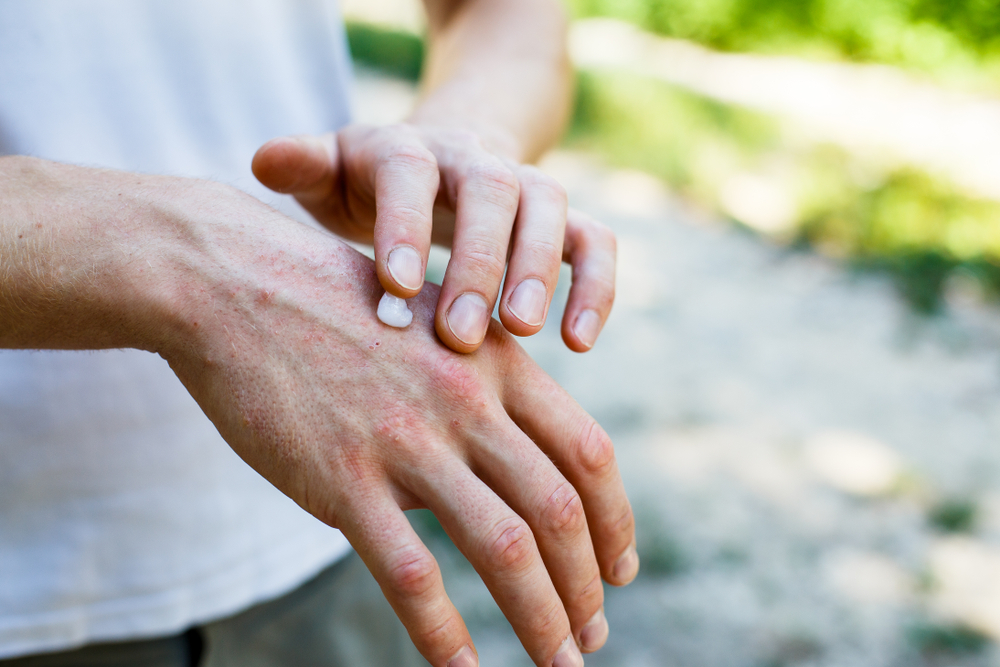 Spośród szerokiej gamy preparatów nawilżających w przebiegu AZS najczęściej rekomendowane są emolienty (fot. Shutterstock).
