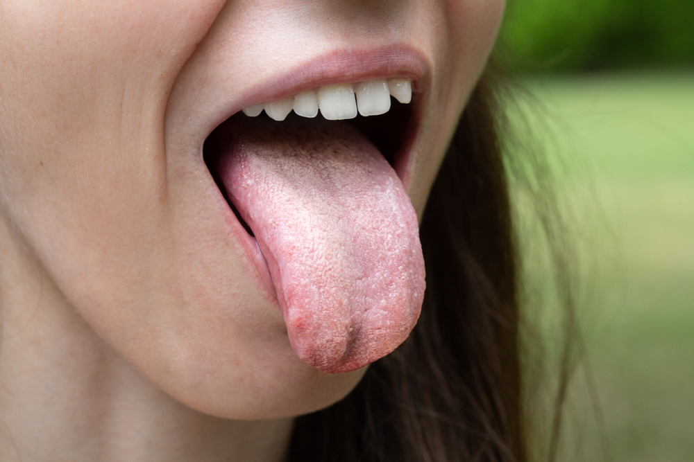W przypadku zlokalizowanej pleśniawki na jej powierzchnię nanosi się niewielką ilość żelu (fot. Shutterstock).